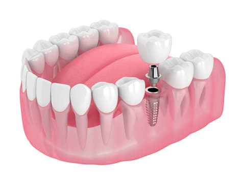 Dental Implants