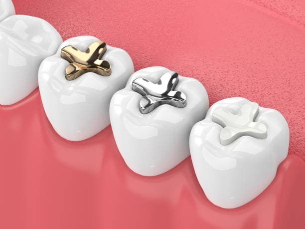 Tooth Colored Fillings